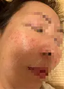 水光注射（ハリ・美肌） / その他（肌） オラクル美容皮膚科 東京新宿院 DAY 1 サムネイル用