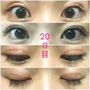 二重切開 銀座高須クリニック DAY 19 サムネイル用