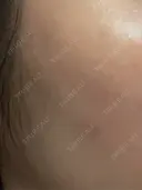 ヒアルロン酸注入（頬） 湘南美容クリニック 大阪梅田本院 DAY 1 サムネイル用