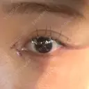目頭切開 9BeautyClinic DAY 4 サムネイル用