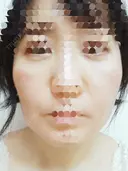 肌ヒアルロン酸注入（たるみ・シワ改善） / シワ取りボトックス 東京形成美容外科 船橋院 DAY 8 サムネイル用