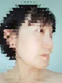 肌ヒアルロン酸注入（たるみ・シワ改善） / シワ取りボトックス 東京形成美容外科 船橋院 DAY 13 サムネイル用