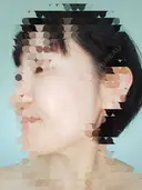 肌ヒアルロン酸注入（たるみ・シワ改善） / シワ取りボトックス 東京形成美容外科 船橋院 DAY 13 サムネイル用