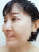 肌ヒアルロン酸注入（たるみ・シワ改善） / シワ取りボトックス 東京形成美容外科 船橋院 DAY 33 サムネイル用