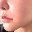 脂肪溶解注射（顔） WellnessPlus Clinic 【ウェルネスプラスクリニック】 AFTER サムネイル用