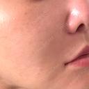 脂肪溶解注射（顔） WellnessPlus Clinic 【ウェルネスプラスクリニック】 DAY 16 サムネイル用