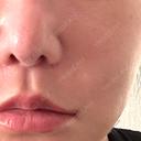 脂肪溶解注射（顔） WellnessPlus Clinic 【ウェルネスプラスクリニック】 DAY 16 サムネイル用