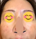 水光注射（ハリ・美肌） / その他（肌） オラクル美容皮膚科 東京新宿院 AFTER サムネイル用