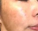 水光注射（ハリ・美肌） / その他（肌） オラクル美容皮膚科 東京新宿院 DAY 4 サムネイル用