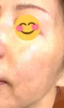水光注射（ハリ・美肌） / その他（肌） オラクル美容皮膚科 東京新宿院 DAY 4 サムネイル用