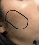 ヒアルロン酸注入（頬） 湘南美容クリニック 大阪梅田本院 DAY 4 サムネイル用