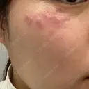 シミ取りレーザー メディカルアルファクリニック AFTER サムネイル用