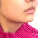 その他（肌） CIEL SKIN CLINIC（シエルスキンクリニック） DAY 2 サムネイル用