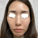 光治療（フォトフェイシャルなど） ミニマムスキンクリニック池袋 DAY 0 サムネイル用