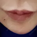 アートメイク（ほくろ） 新宿クレアクリニック AFTER サムネイル用