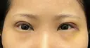 眼瞼下垂（切開） 渋谷の森クリニック DAY 7 サムネイル用