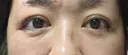 糸リフト / 眉下切開 湘南美容クリニック 表参道院 DAY 13 サムネイル用