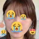 切開リフト 東京エビスクリニック DAY 15 サムネイル用