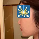 ジョールファット除去 / 脂肪吸引注射（顔） 湘南美容クリニック 大阪梅田本院 DAY 13 サムネイル用