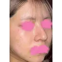 光治療（フォトフェイシャルなど） CIEL SKIN CLINIC（シエルスキンクリニック） DAY 0 サムネイル用