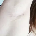 豊胸（シリコンバッグ） / 胸修正 NANA（ナナ）美容外科 DAY 25 サムネイル用