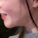 糸リフト / バッカルファット除去 / 脂肪吸引（顔） / ジョールファット除去 BLINC CLINIC （ブリンク クリニック） DAY 97 サムネイル用