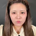 二重埋没 / ヒアルロン酸注入（涙袋） / ヒアルロン酸注入（あご） R Beauty CLINIC 名古屋院 DAY 376 サムネイル用
