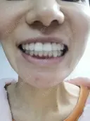 矯正（マウスピース） 銀座青山You矯正歯科 池袋西口医院 DAY 223 サムネイル用