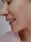 矯正（マウスピース） 銀座青山You矯正歯科 池袋西口医院 DAY 223 サムネイル用