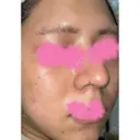 光治療（フォトフェイシャルなど） CIEL SKIN CLINIC（シエルスキンクリニック） AFTER サムネイル用