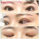 二重埋没 城本クリニック 福岡院 DAY 6 サムネイル用