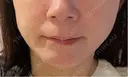 糸リフト / シワ取りボトックス 銀座美容外科クリニック 銀座院 AFTER サムネイル用