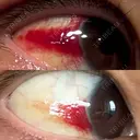 切開リフト 東京エビスクリニック DAY 19 サムネイル用