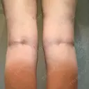 脂肪溶解注射 カイ整形外科・皮膚科 DAY 33 サムネイル用