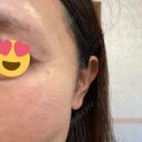 ヒアルロン酸注入（涙袋） / ボトックス（目尻） / ボトックス（額） / ボトックス（ガミースマイル） Code Beauty Clinic 名古屋院 AFTER サムネイル用
