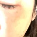 ヒアルロン酸溶解 芦屋美容クリニック 芦屋院 AFTER サムネイル用