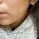 ハイフ（顔） 新宿中央クリニック DAY 1 サムネイル用