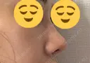 鼻尖形成（切開） / 鼻尖縮小 / 小鼻縮小（非切開） 銀座マイアミ美容外科 DAY 18 サムネイル用