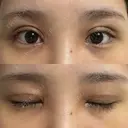 二重切開 / 目頭切開 オーキッド美容クリニック東京御徒町 DAY 10 サムネイル用
