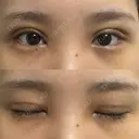 二重切開 / 目頭切開 オーキッド美容クリニック東京御徒町 DAY 11 サムネイル用