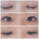 二重埋没 / その他（目元） / 上まぶたの脂肪取り 東京形成美容外科 船橋院 DAY 29 サムネイル用