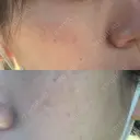 光治療（フォトフェイシャルなど） 小木曽クリニック DAY 3 サムネイル用