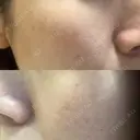 光治療（フォトフェイシャルなど） 小木曽クリニック DAY 4 サムネイル用