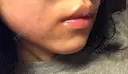 ヒアルロン酸注入（唇） / ボトックス（口角） TCB東京中央美容外科 堺院 DAY 6 サムネイル用