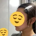 糸リフト / 脂肪吸引（顔） A CLINIC（エークリニック） 大阪院 DAY 0 サムネイル用