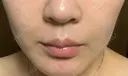 美容点滴・美容注射（美肌） / ヒアルロン酸注入（鼻翼基部） ヴェリテクリニック 大阪院 DAY 2 サムネイル用