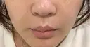 美容点滴・美容注射（美肌） / ヒアルロン酸注入（鼻翼基部） ヴェリテクリニック 大阪院 AFTER サムネイル用