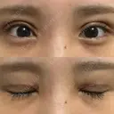 二重切開 / 目頭切開 オーキッド美容クリニック東京御徒町 DAY 12 サムネイル用