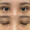 二重切開 / 目頭切開 オーキッド美容クリニック東京御徒町 DAY 13 サムネイル用