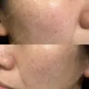 光治療（フォトフェイシャルなど） 小木曽クリニック DAY 4 サムネイル用